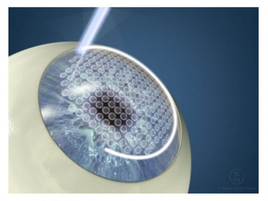 I-LASIK-soorocaba