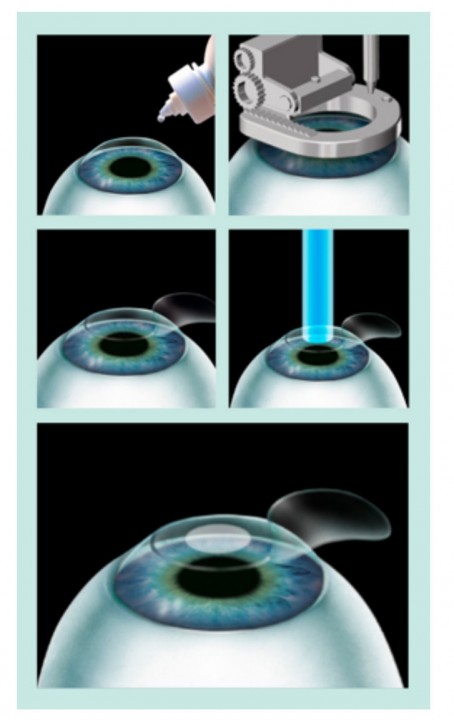 LASIK-mutton-sorocaba
