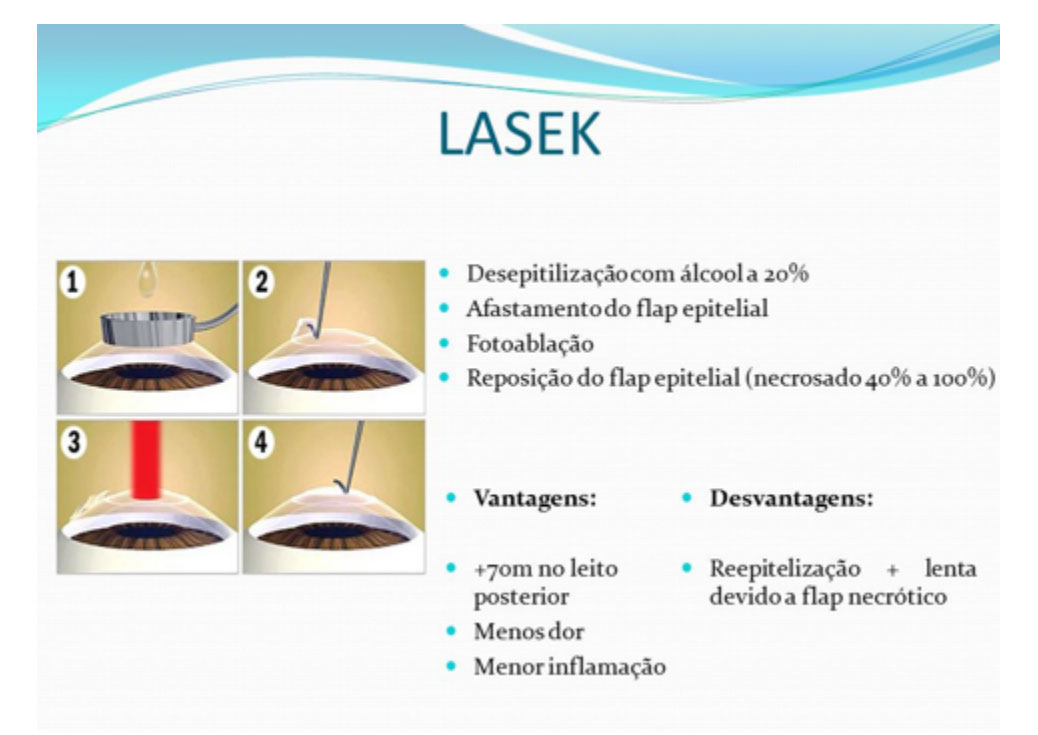 lasek-sorocaba