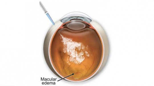 macular-edema