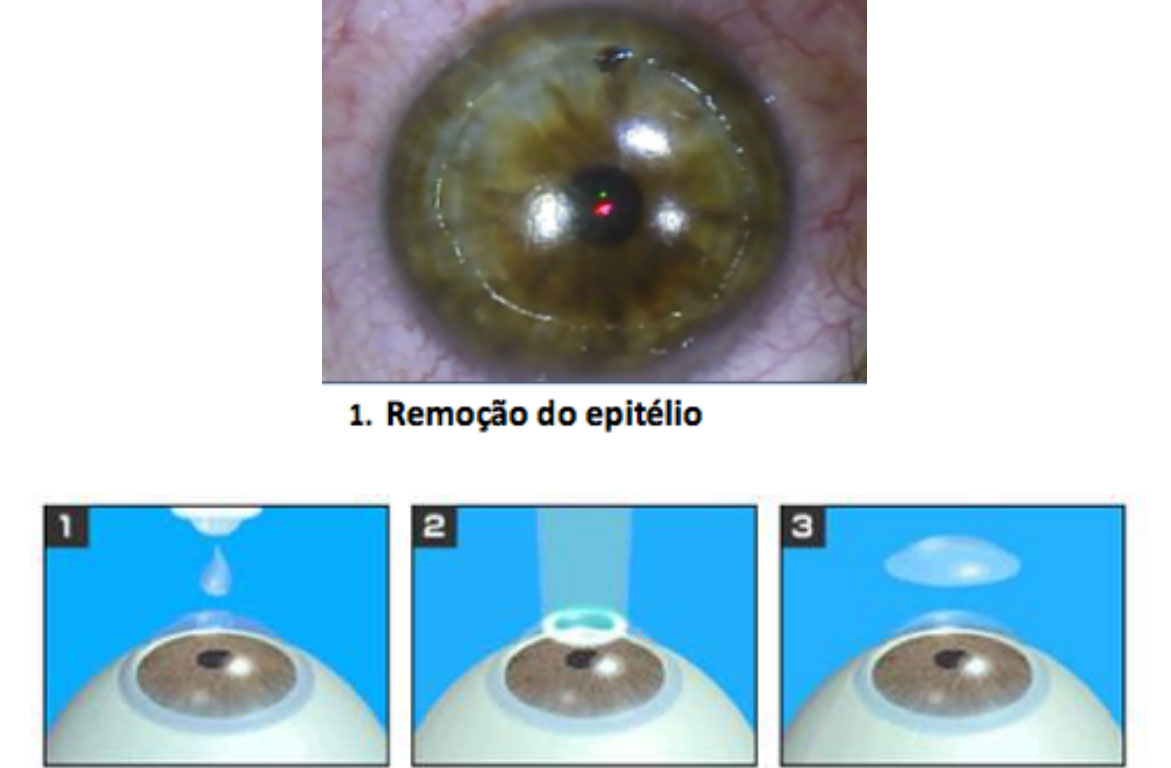 Cirurgia Refrativa