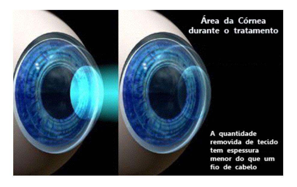 tratamento-da-cornea-sorocaba