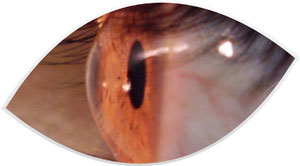 ceratocone-clinica-oftalmologia-mutton-sorocaba