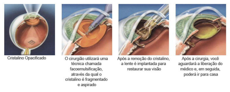 cristalino-oftalmologia-mutton