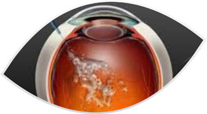 medicações intra oculares-clinica-oftalmologia-mutton-sorocaba