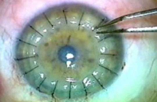 transplante-cornea-sorocaba