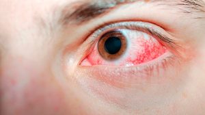 Hemorragia Subconjuntival Conhecida Como Derrame Nos Olhos Um